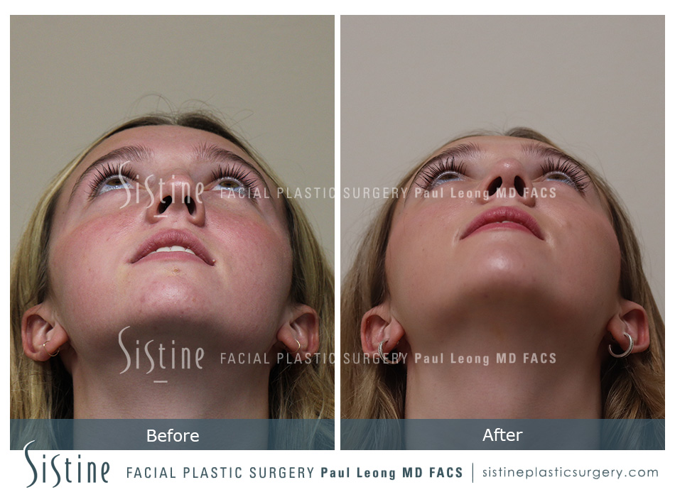 Southside Pittsburgh Rhinoplasty - Preoperative Patient View | Paul Leong MD