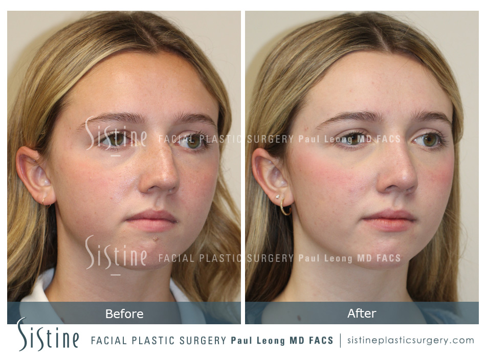 Pittsburgh/Highland Park Rhinoplasty - Preoperative Patient View | Sistine Facial Plastic Surgery