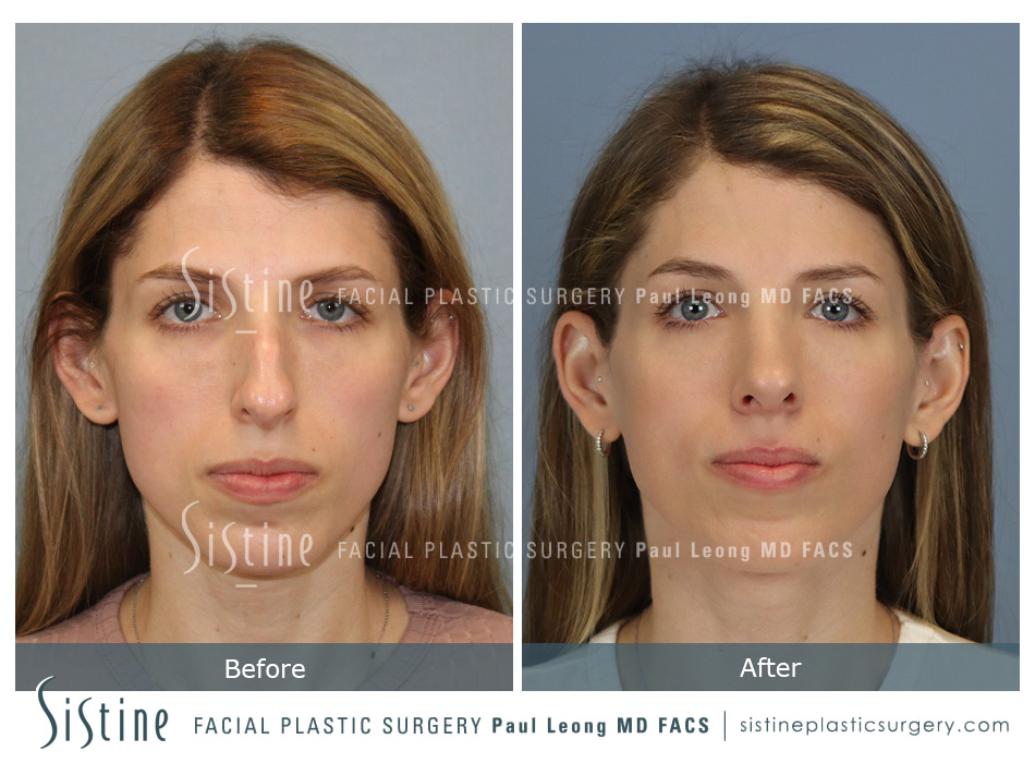 Female Rhinoplasty - Patient Preoperative View | Sistine Facial Plastic Surgery