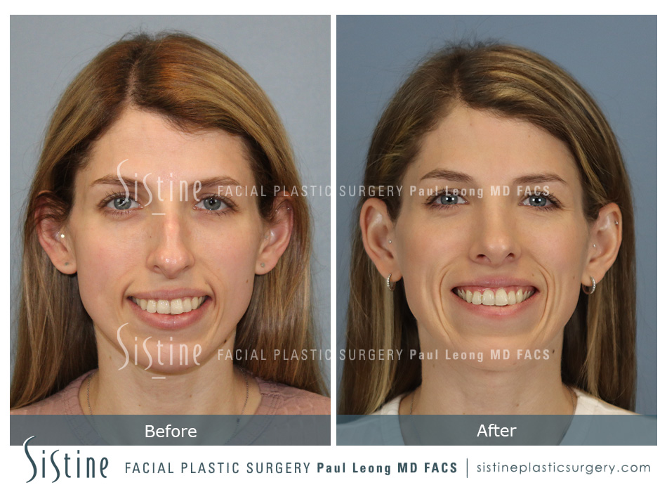 Wexford PA Cosmetic Rhinoplasty - Preoperative Patient Image | Dr. Paul Leong