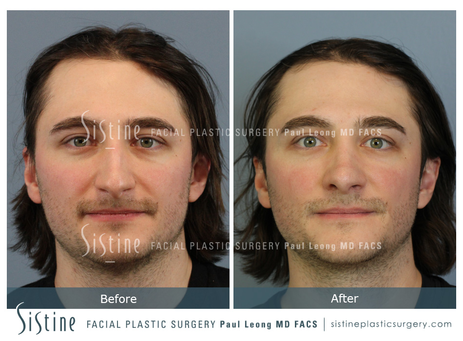 Rhinoplasty Recovery Photos - Preoperative Image | Dr. Paul Leong, Pittsburgh PA