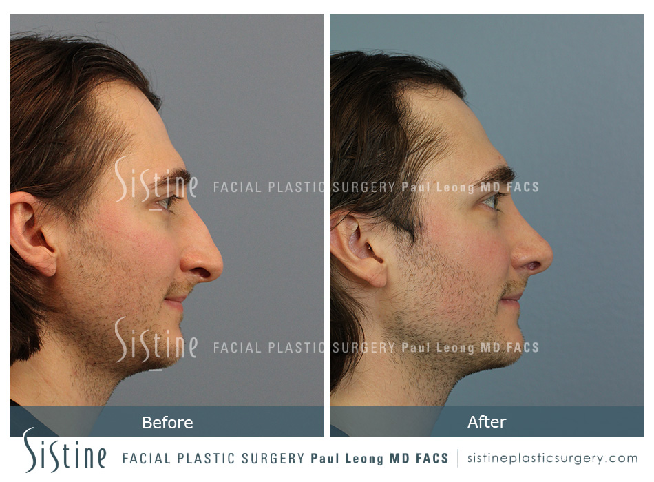 Male Rhinoplasty Pittsburgh - Preoperative Patient Image | Dr. Paul Leong
