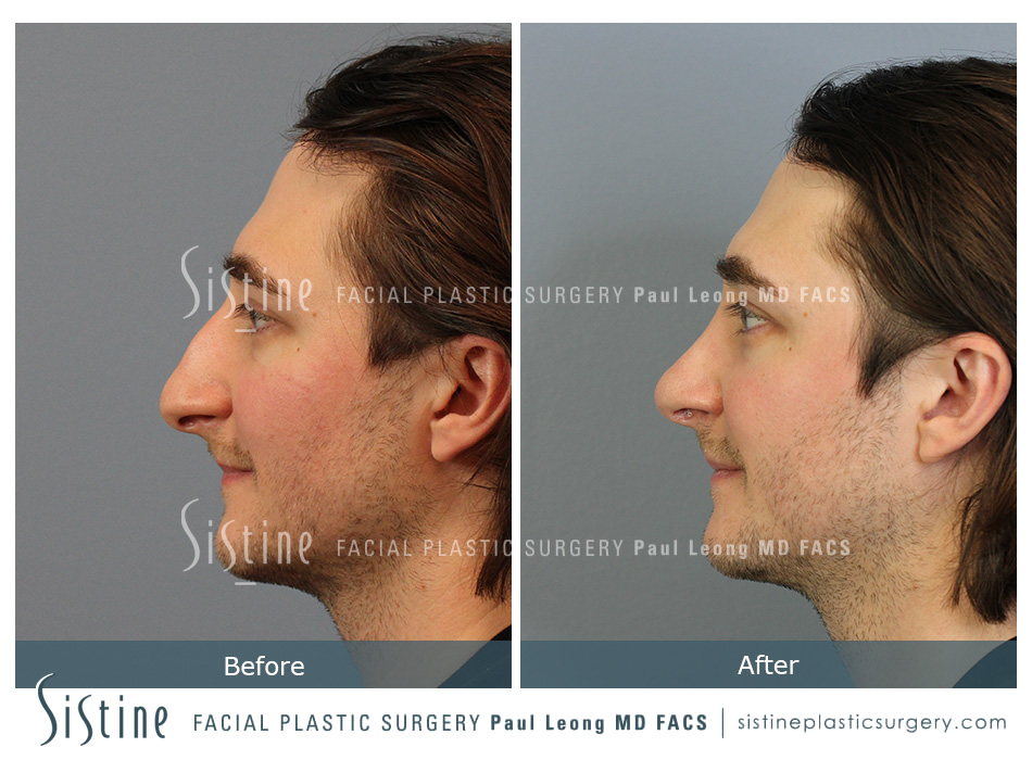 Tip Rhinoplasty - Preoperative Image | Dr. Paul Leong - Pittsburgh PA