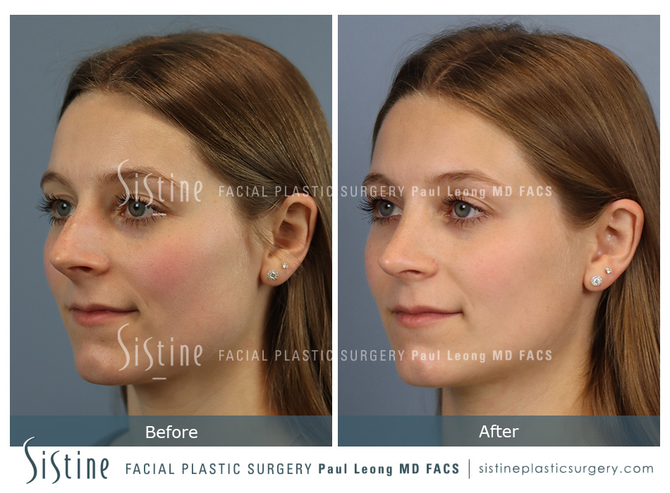 Photos of Nose Reshaping Surgery - Preoperative Patient Image | Paul Leong MD