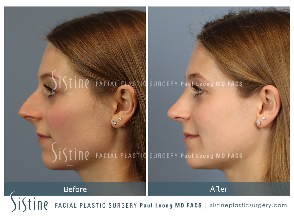 Rhinoplasty Surgery Southside Works - Preoperative View | Paul Leong MD