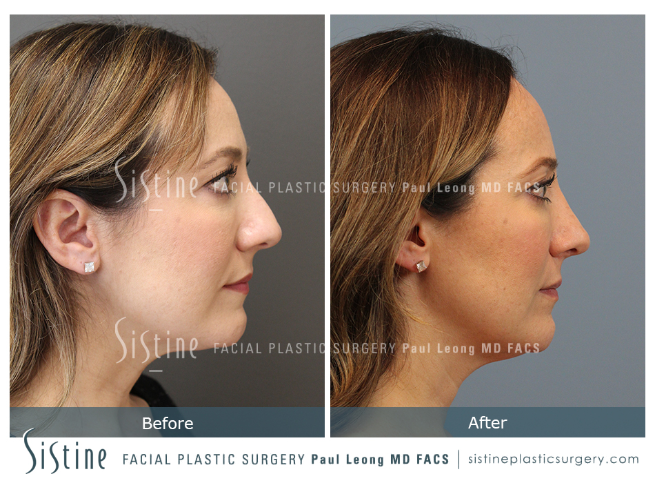 Dorsum Hump Reduction Rhinoplasty - Preoperative Right Lateral View | Dr. Paul Leong