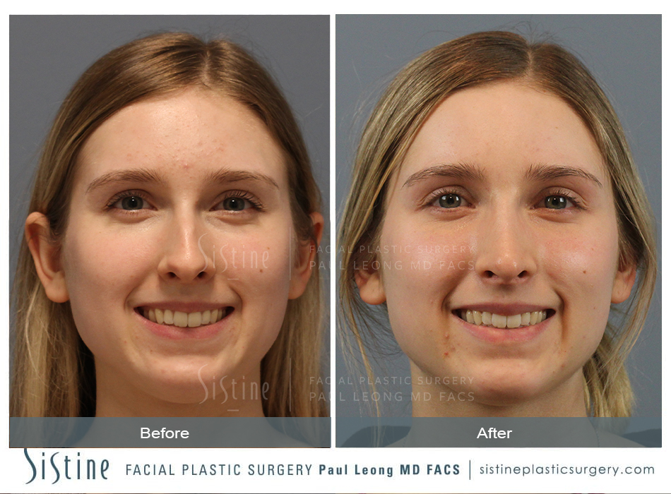Dorsal Augmentation Rhinoplasty - Preoperative View | Dr. Leong, Pittsburgh PA