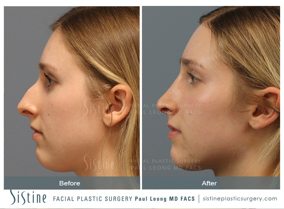 Upturned Nose Tip After Rhinoplasty - Preoperative Right Lateral View | Dr. Paul Leong
