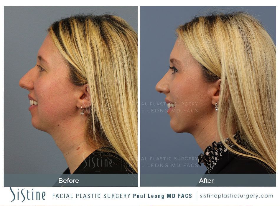 Functional Rhinoplasty Pittsburgh - Right Oblique Preoperative View | Dr. Paul Leong
