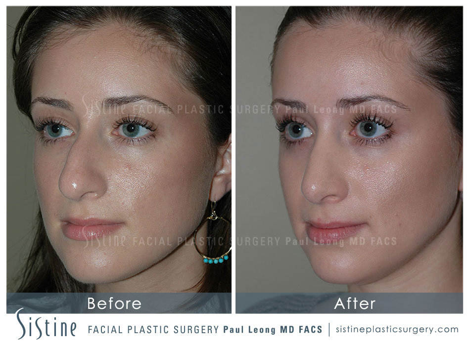 Top Rhinoplasty Surgeons in the World - Preoperative Patient Left Lateral View | Paul Leong MD in Pittsburgh PA