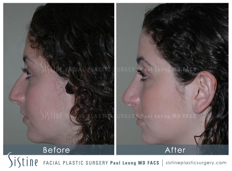 Pittsburgh/Highland Park Rhinoplasty - Preoperative Patient View | Sistine Facial Plastic Surgery