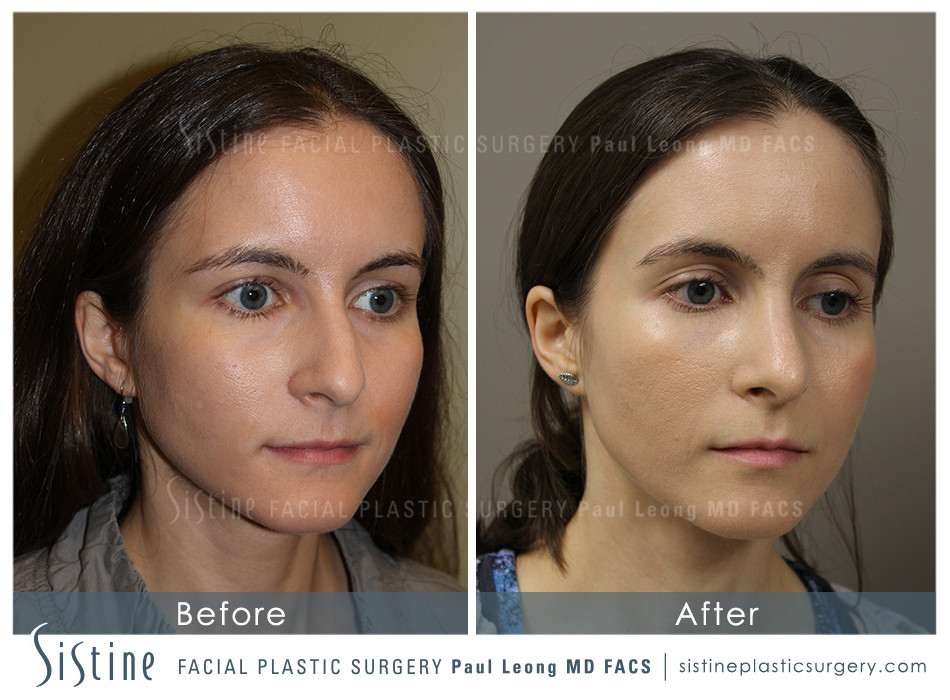 Wexford PA Cosmetic Rhinoplasty - Preoperative Patient Image | Dr. Paul Leong