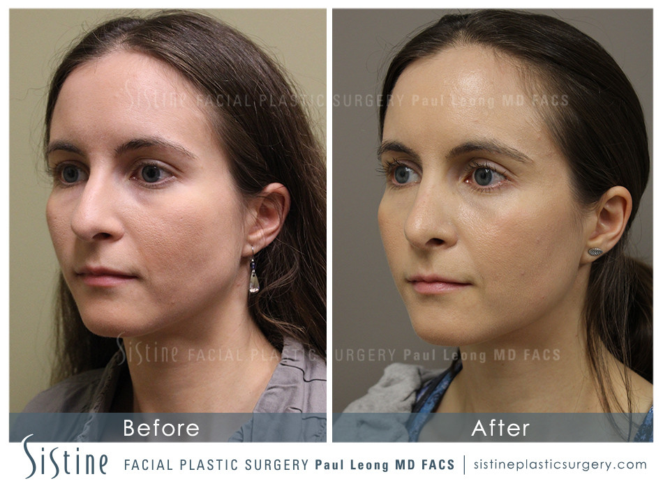 Highland Park Pittsburgh Cosmetic Rhinoplasty - Preoperative Patient Image | Paul Leong MD