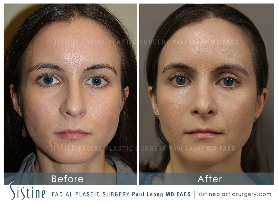 Highland Park Pittsburgh Cosmetic Rhinoplasty - Preoperative Patient Image | Paul Leong MD