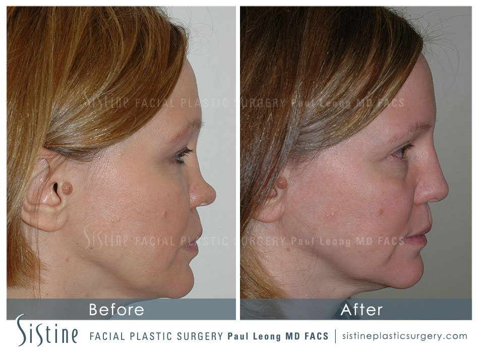 Pittsburgh PA Nose Reshaping Surgery - Preoperative Patient Image | Dr. Paul Leong