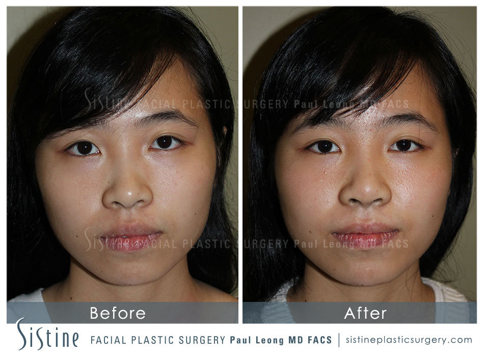 Female Rhinoplasty - Patient Preoperative View | Sistine Facial Plastic Surgery