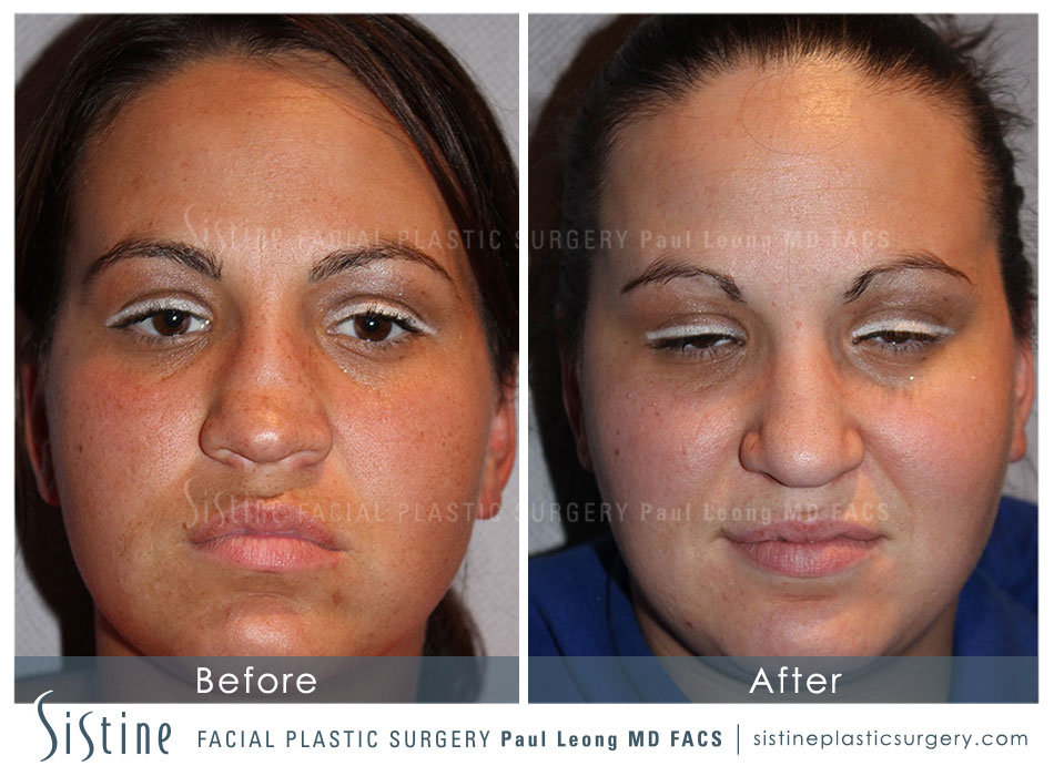 Pittsburgh Rhinoplasty Deviated Septum - Frontal Preoperative View | Sistine Facial Plastic Surgery 