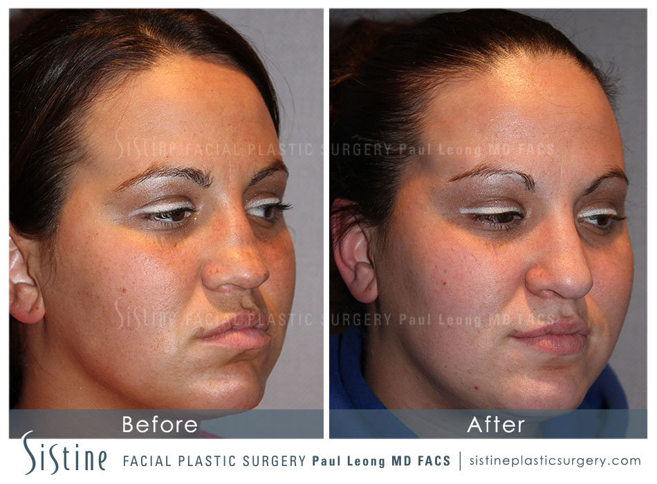 Rhinoplasty Septum Repair - Left Oblique Preoperative View | Sistine Facial Plastic Surgery