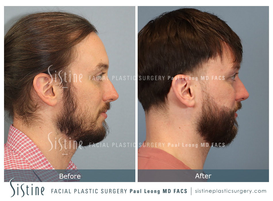 Restylane Dermal Fillers for Tear Trough - Before Treatment | Dr. Paul Leong, Pittsburgh PA