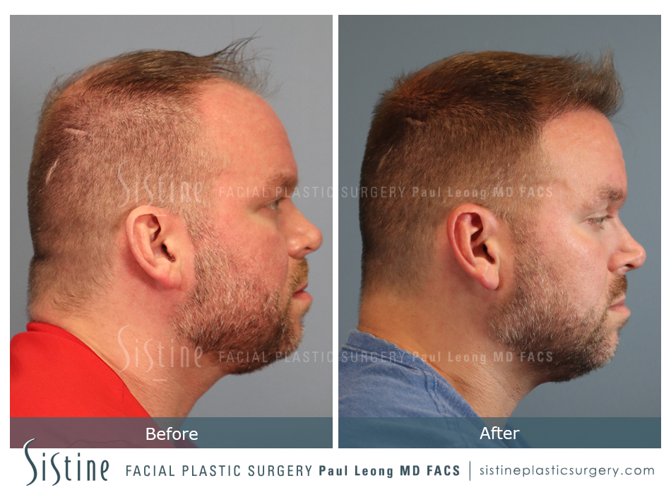 Hair Transplant Before and After 04 | Sistine Facial Plastic Surgery