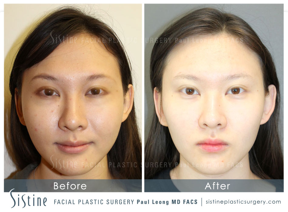 Asian Non Surgical Innovations Before and After | Sistine Facial Plastic Surgery