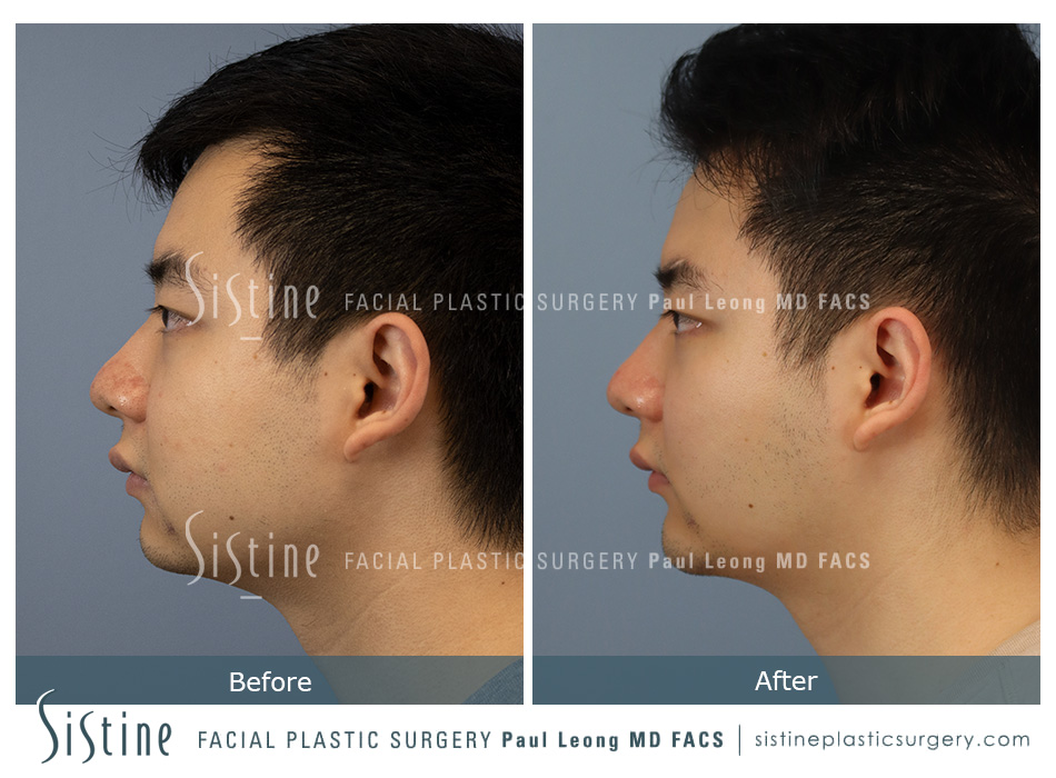 Chin Augmentation - Patient Preoperative View | Dr. Paul Leong