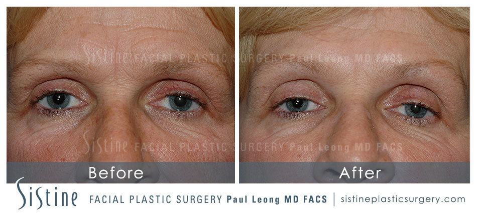 Forehead Botox Pittsburgh PA - Before Image | Sistine Facial Plastic Surgery