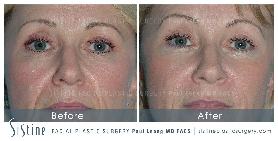 Sculptra® Aesthetic in Pittsburgh PA - Before Image | Sistine Facial Plastic Surgery 