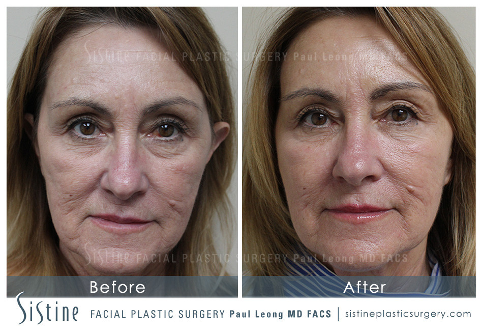 ﻿Restylane® Filler for Tear Troughs in Pittsburgh, PA - Before Photos | Sistine Facial Plastic Surgery 