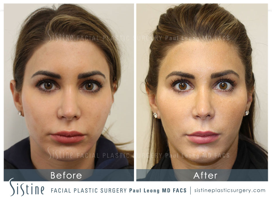 Non-Surgical Jawline Slimming Treatment - Before Image | Paul Leong MD, Pittsburgh Southside Works