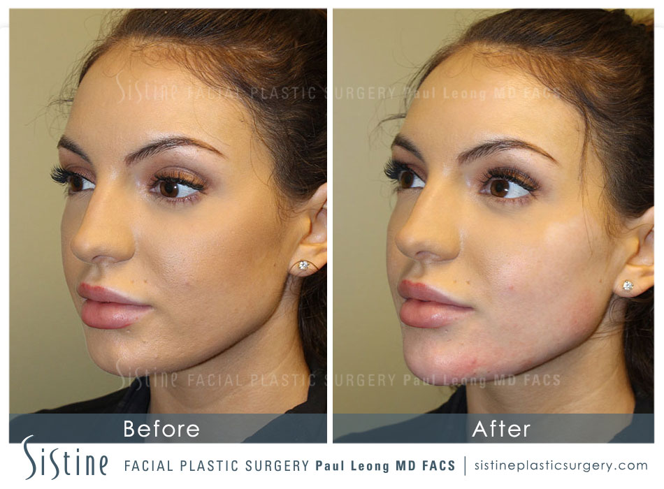 Chin Augmentation Before and After | Sistine Facial Plastic Surgery