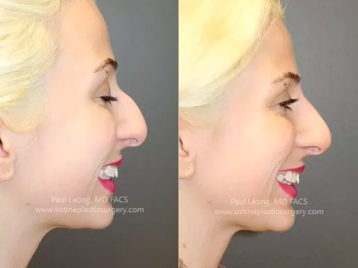 Non-Surgical Rhinoplasty in Pittsburgh PA - Before Image | Sistine Facial Plastic Surgery