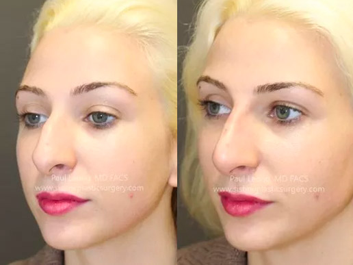 Sewickley PA Non-Surgical Rhinoplasty - BEFORE Photo | Sistine Facial Plastic Surgery