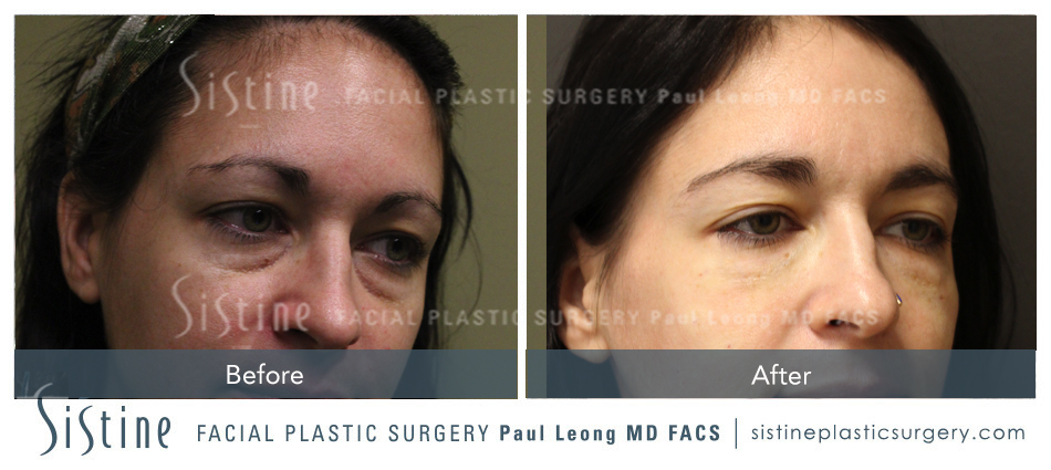 Dermal Fillers Before and After | Sistine Facial Plastic Surgery