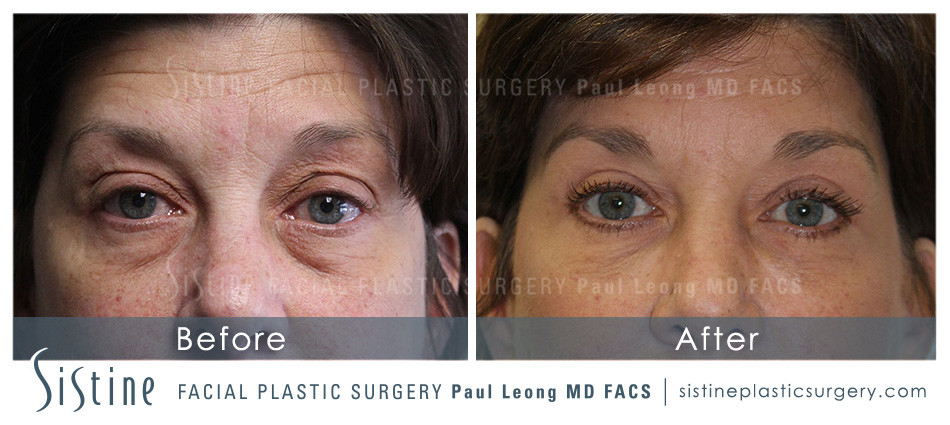 Tear Trough Treatment with Restylane - Before Photo | Sistine Facial Plastic Surgery
