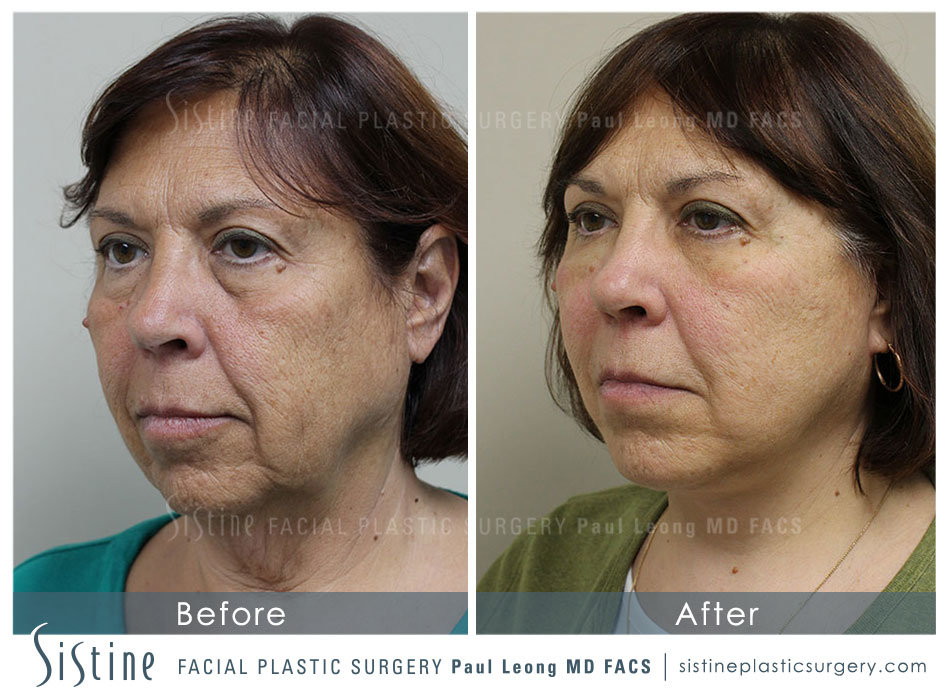 Restylane Injection Tear Trough - Before Image | Sistine Facial Plastic Surgery - Pittbsurgh PA