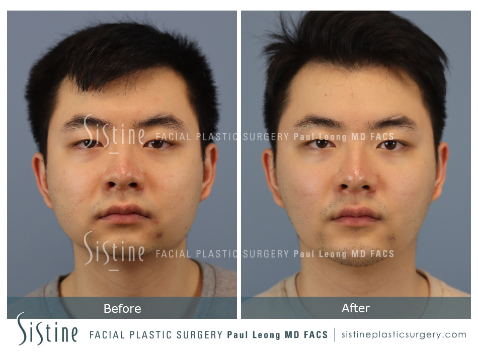 Chin Augmentation - Patient Preoperative View | Sistine Facial Plastic Surgery