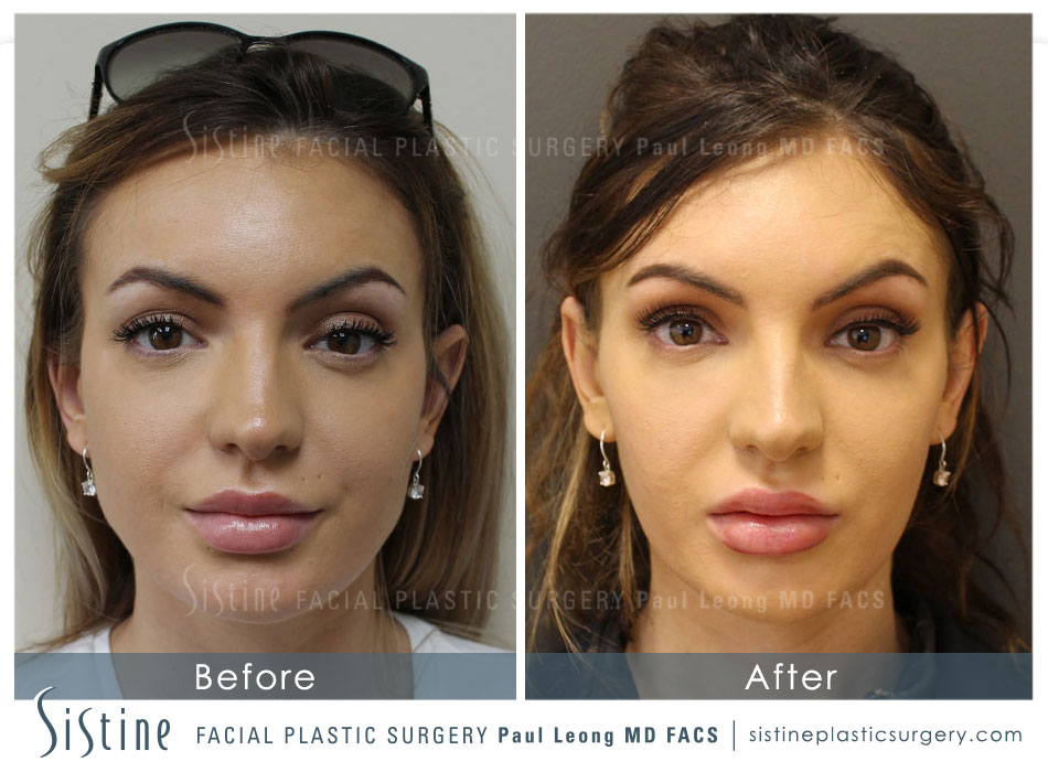 Jawline Slimming Before and After | Sistine Facial Plastic Surgery