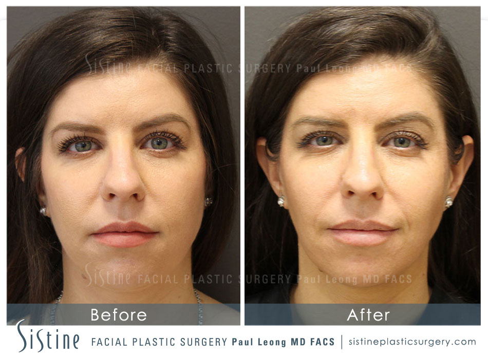 Sculptra Injections - Before Image | Dr. Paul Leong, Pittsburgh PA