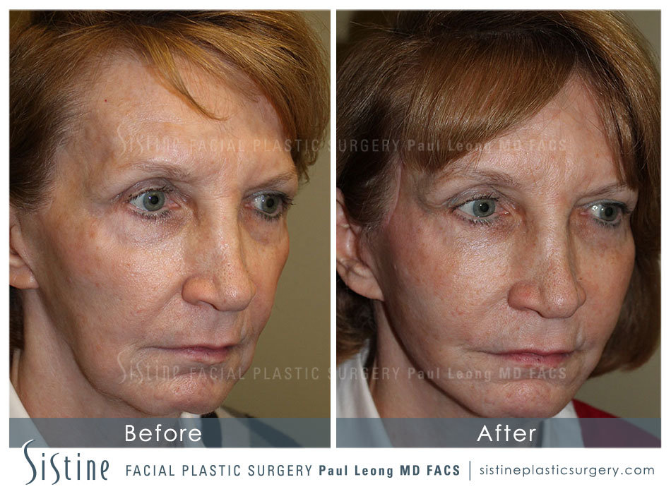 Sculptra Face Injections - Before Image | Sistine Facial Plastic Surgery, Wexford PA