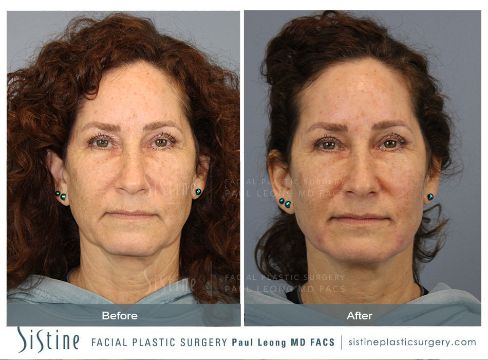 Jawline Slimming Before and After | Sistine Facial Plastic Surgery