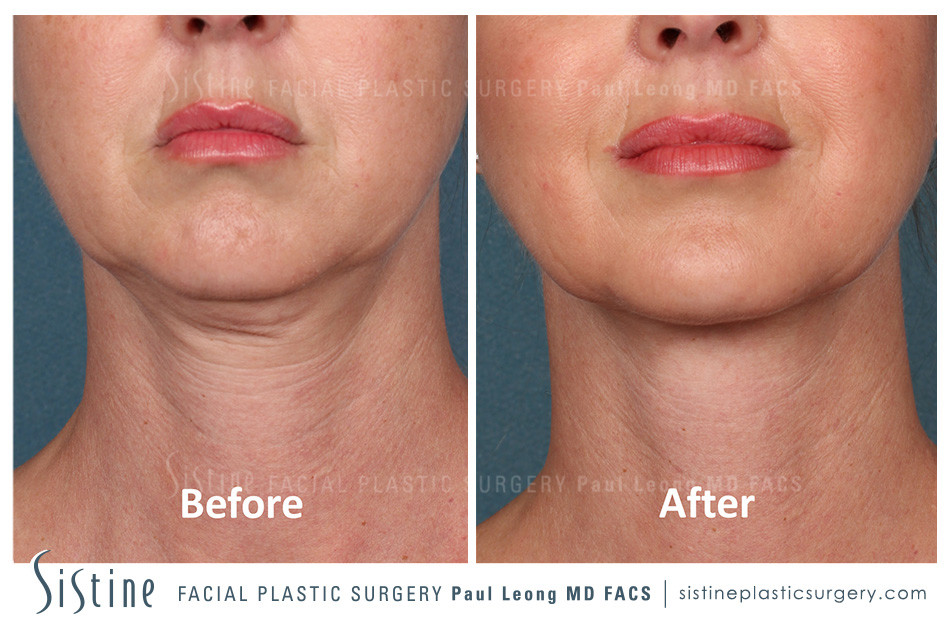 Non-Surgical Double Chin Treatment - Before Image | Paul Leong MD, Pittsburgh Southside Works