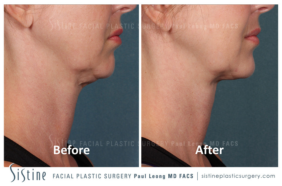Kybella Before and After | Sistine Facial Plastic Surgery