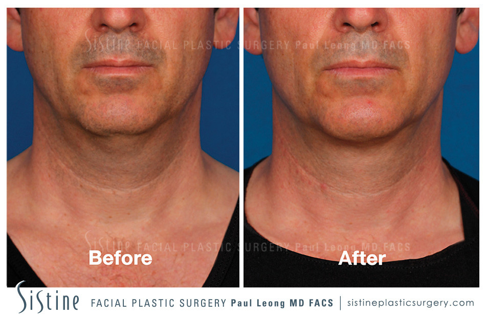 Pittsburgh PA Kybella Injections - Before Image | Sistine Facial Plastic Surgery