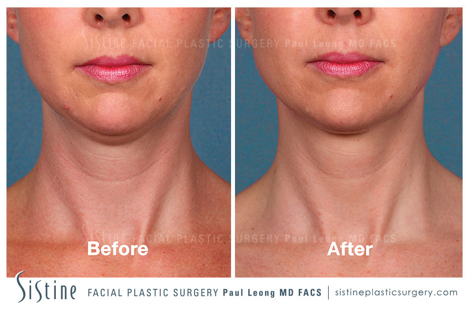 Non-Surgical Double Chin Treatment Pittsburgh PA - Before Image | Sistine Facial Plastic Surgery