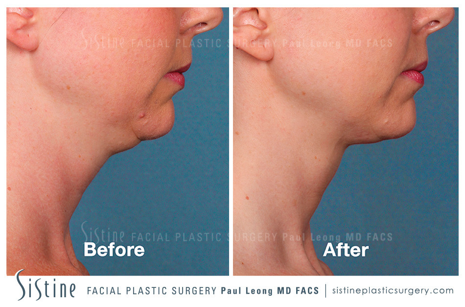 Non-surgical Double Chin Fat Removal - Kybella | Before Image | Sistine Facial Plastic Surgery