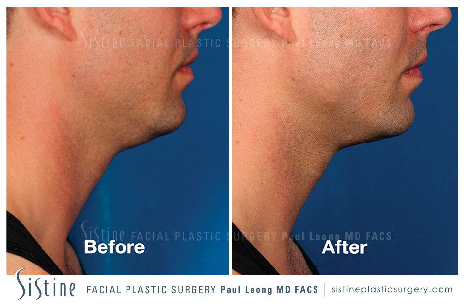 Non-Surgical Chin Liposuction - Kybella - Before Image | Sistine Facial Plastic Surgery Pittsburgh PA