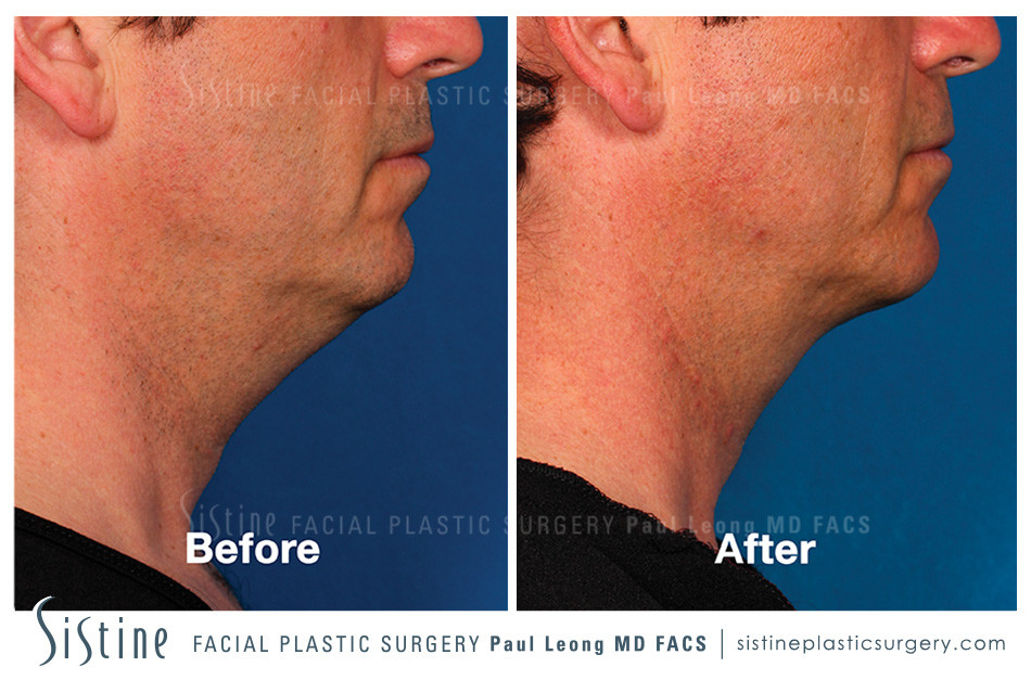 Kybella Injections - Before Image | Sistine Facial Plastic Surgery Pittsburgh PA