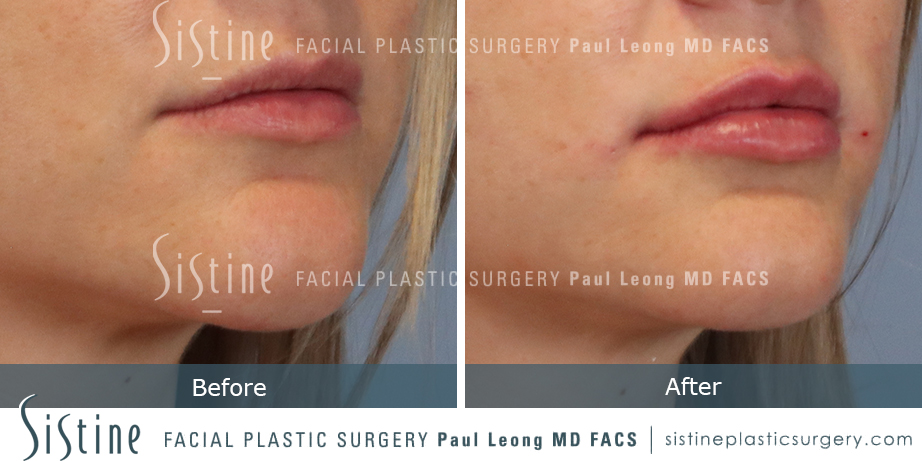 Lip Augmentation Before and After | Sistine Facial Plastic Surgery