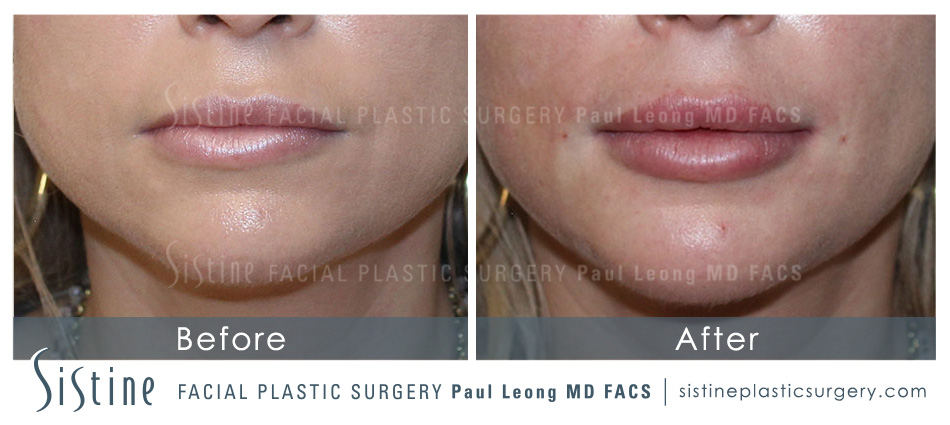 Lip Augmentation Before and After | Sistine Facial Plastic Surgery